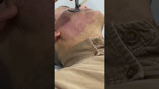 Erase Scars Fast with CO2 Fractional Laser Treatment shortvideo scarremoval [upl. by Tersina]