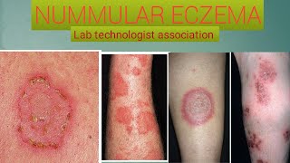 What is nummular eczema ans how to cure [upl. by Inafetse]