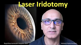 Laser Iridotomy the works Mahesh Ramchandani explores all about laser for angle closure glaucoma [upl. by Merlina]