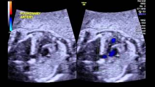 Tetralogy of Fallot with pulmonary stenosis 3 vessel view [upl. by Eihcra]