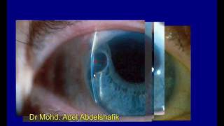 Slit lamp examination  whole presentation [upl. by Ennaid]