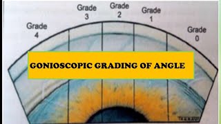 5 Gonioscopy grading systems and Diagrammatic representation [upl. by Arol]