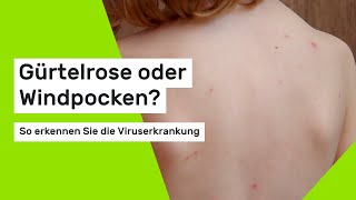 Gürtelrose oder Windpocken So erkennen Sie die Viruserkrankung [upl. by Adnoluy]