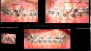 Orthodontic Treatment  Class III  Time Lapse [upl. by Pasco]