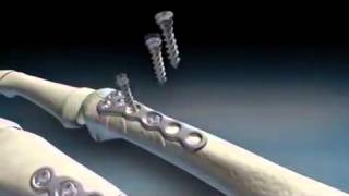 OsteoMed HPS System Innovation in Surgical Screw and Plate Systems [upl. by Dearborn]