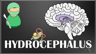 Hydrocephalus  Causes Types Signs and Symptoms Pathophysiology Diagnosis and Treatment [upl. by Yetah]