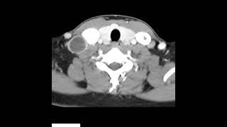 Tbc ganglionar cervical [upl. by Aititil421]