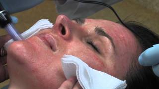 Dr Mark B Taylor Review of Dermapen Micro Needling  Gateway Aesthetics [upl. by Fairley]