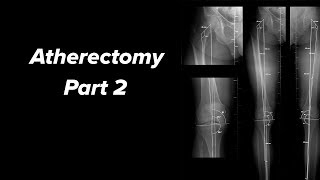 Atherectomy for Peripheral Arterial Occlusive Disease  Part 2 [upl. by Drolet]