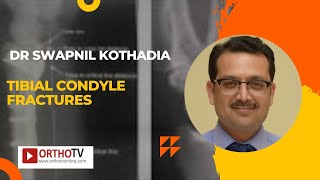 Tibial Condyle Fractures by Dr Swapnil Kothadia [upl. by Irpac]