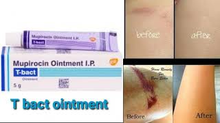 T bact ointment uses in telugu best ointment for cuts burns and marks [upl. by Cheryl]