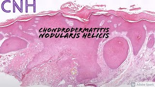 Chondrodermatitis Nodularis Helicis CNH 5Minute Pathology Pearls [upl. by Crowley524]