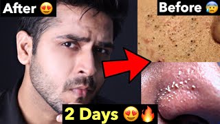 How to Remove Blackheads Whiteheads Naturally  Tips To Remove Whiteheads Blackheads From FACE [upl. by Inirt]