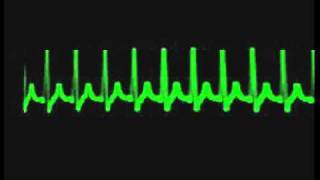 taquicardia supraventricular [upl. by Revkah210]