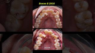 Cost  2500 for this case Braces crooked teeth braces orthodontist dentist [upl. by Uni77]