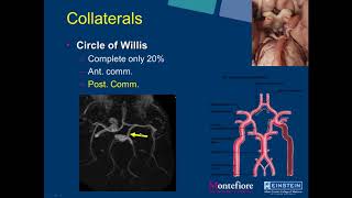 SIRRFS Webinar 2272018 Neuro Interventional Radiology Carotid Artery Stenting [upl. by Childs]