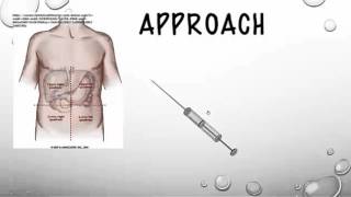 The Therapeutic Paracentesis tricks of the trade [upl. by Elenaj]