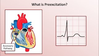 Advanced EKGs  WolffParkinsonWhite WPW Syndrome [upl. by Noivart]