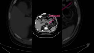 Acute calculus cholecystitis [upl. by Hemminger]