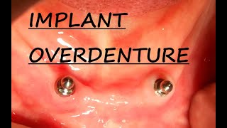 Implant Overdenture Planning  Part 1 Implant Supported Overdenture  Step by Step Planning [upl. by Ynwat]