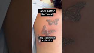 Laser Tattoo Removal [upl. by Kronick]