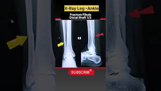 Fracture Fibula bone  xray Leg with ankle xray shorts [upl. by Rratsal338]