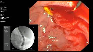 ERCP  GS cholecystitis with CT showed CBD stone 5mm 27 10 2567 [upl. by Aedrahs74]