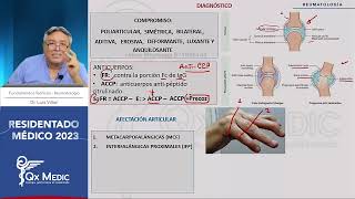 Reumatología  6 Artritis Reumatoide AR [upl. by Adalheid]