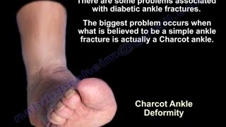 Diabetic Ankle Fractures  Everything You Need To Know  Dr Nabil Ebraheim [upl. by Franckot]