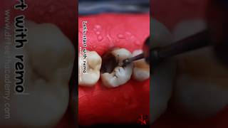 How is Root Canal Treatment RCT done dentist rct [upl. by Uzia586]