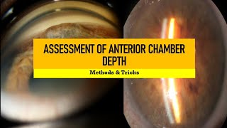 ANGLE DEPTH ASSESSMENT and GRADING  Van Herrick smith pen torch limbal split technique and more [upl. by Nylynnej]