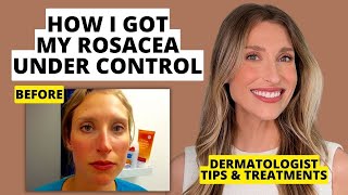 My Rosacea Journey Dermatologist Shares Skincare amp Treatments That Work  Dr Sam Ellis [upl. by Nyrmac]