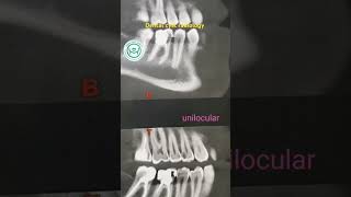 Dental cyst radiology حويصلات الفكين [upl. by Kwabena461]