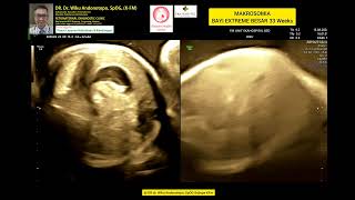 Makrosomia bayi extreme besar 33 weeks [upl. by Kowal]