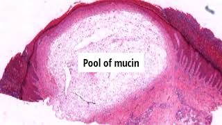 Pathology of Digital Mucous Myxoid Cyst by Dr Sampurna Roy MD  dermatopathology dermpath [upl. by Rosanna]