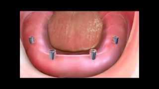 Implant Supported Dentures [upl. by Leinahtan187]