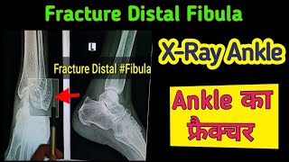 Fracture Distal Fibula  Fracture Lateral Malleolus  XRay Ankle joint  UdayXRay [upl. by Anirhtak272]