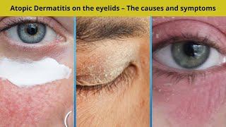 Atopic Dermatitis on the eyelids – The causes and symptoms  Nuse Healthy [upl. by Aisemaj879]