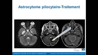 Tumeurs cérébrales pédiatriques types de tumeurs effets secondaires des traitements et recherche [upl. by Krever]