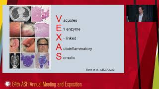 5Inflammaging comorbidities and VEXAS syndrome in MDS pathogenesis [upl. by Kieryt]