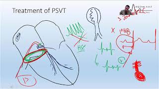 the Exact place of the slow AVN pathway and How we ablate AVNRT [upl. by Feodore]