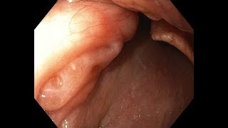 Standard EGD with OLGAOLGAIM biopsy [upl. by Akinaj]