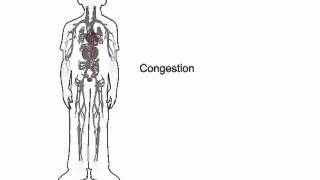 How heart failure causes fluid accumulation  wwwheartfailuremattersorg [upl. by Constance434]