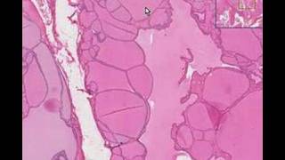 Histopathology ThyroidColloid goiter [upl. by Lladnar]