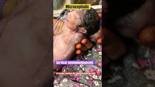 Cervical Myelomeningocele microcephaly vitaminb9 neuraltubedefects drsreedhargandikota [upl. by Namas]