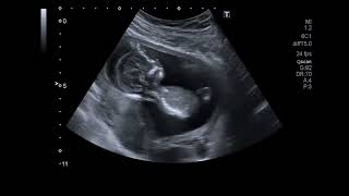 Beautiful Ultrasound Video of 14 Weeks Pregnancy Baby Girl [upl. by Hazem]