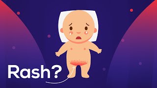 Diaper Rash Due to Baby Urine or Fungus amp Helpful tips to cure [upl. by Good]