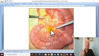 Peritoneal Disorders in Arabic 4 Acute Non Specific Mesenteric Lymphadenitis   by Dr Wahdan [upl. by Manheim539]