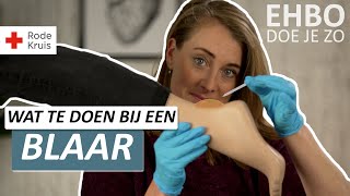 Met vuur de naald ontsmetten  Hoe behandel je blaren  Rode Kruis EHBO [upl. by Grimona]