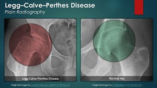 LeggCalvePerthes Disease Plain Radiography [upl. by Mirak290]